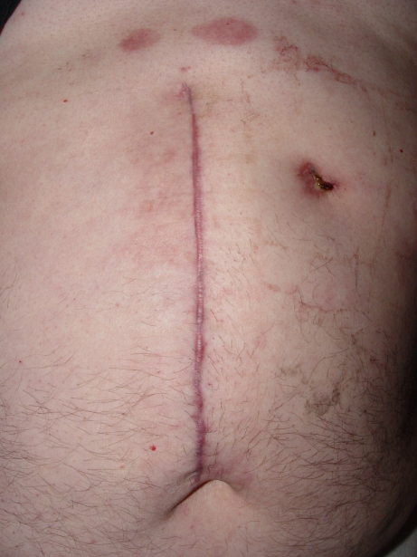 gallbladder surgery scars pictures. from Stomach+surgery+scar