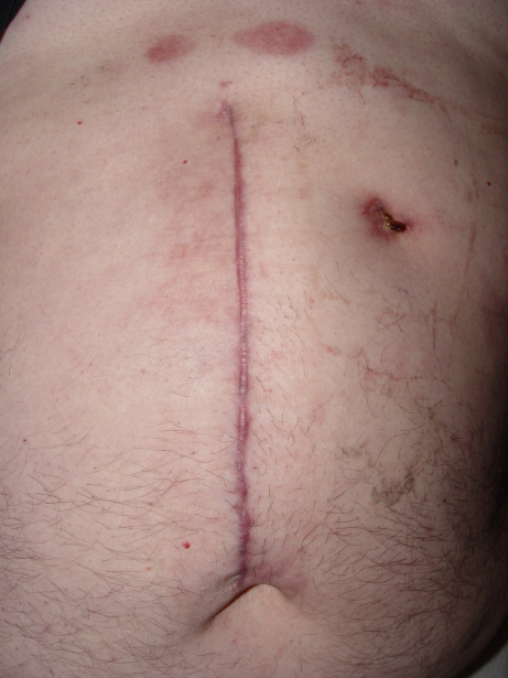 from Stomach+surgery+scar gallbladder surgery scars pictures. from Stomach+surgery+scar